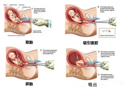 四个月无痛引产步骤详解