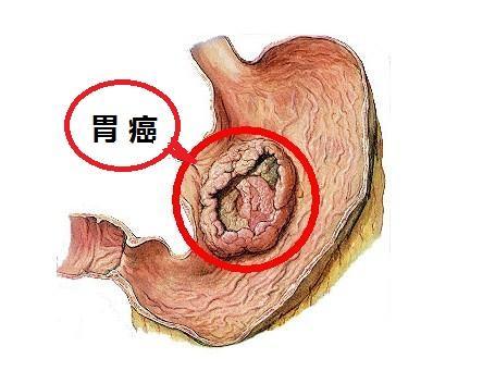 咽喉下垂一个月，症状、原因及治疗方法